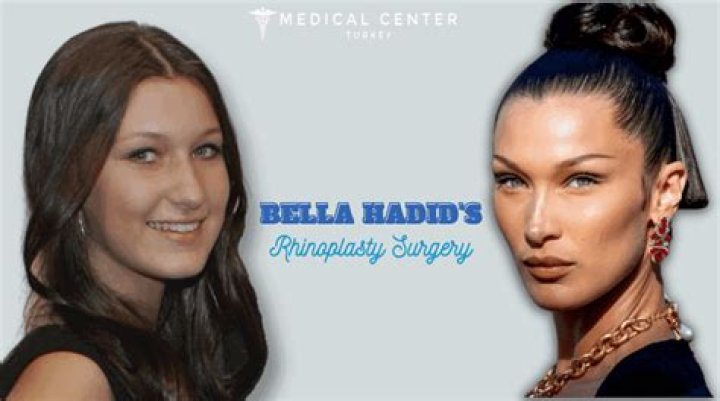 Experts and Doctors Debate Bella Hadid’s Plastic Surgery