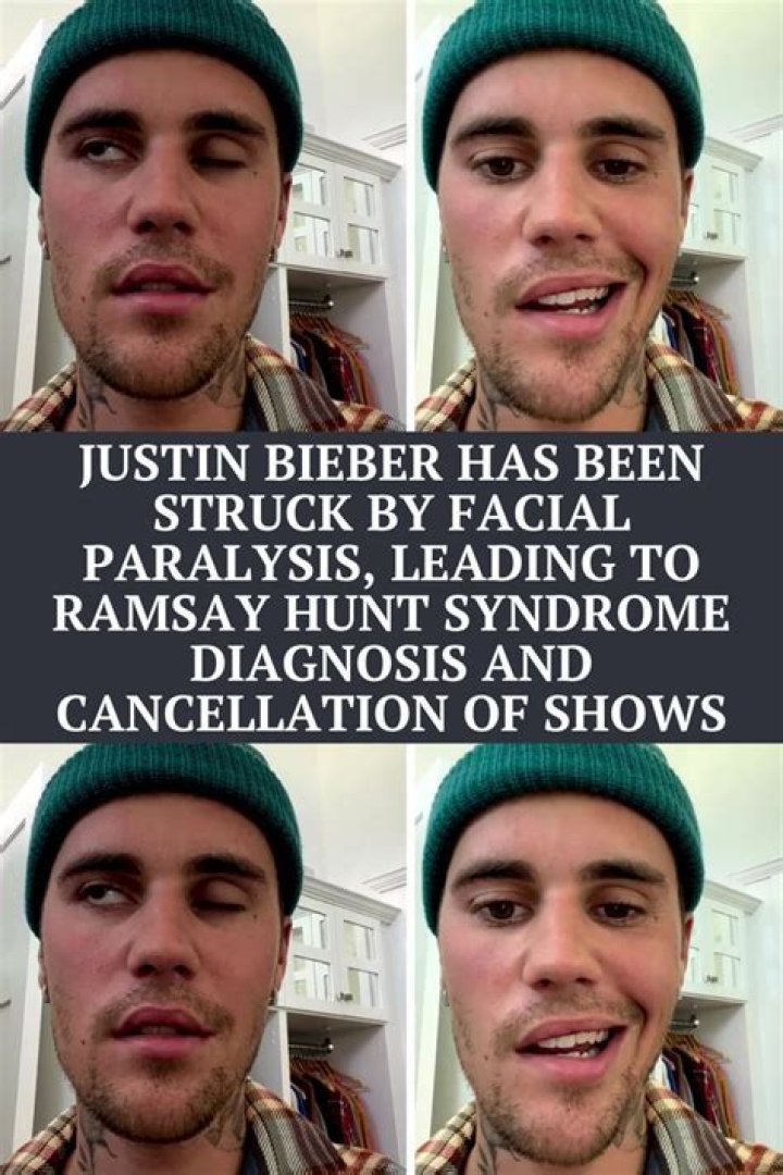 Justin Bieber Is Diagnosed With Ramsay Hunt Syndrome