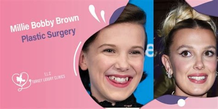 Millie Bobby Brown Plastic Surgery: Before And After Look